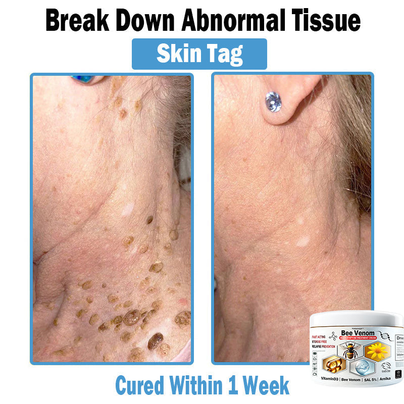 ♻️Skin Tag — Complete Relief Solution