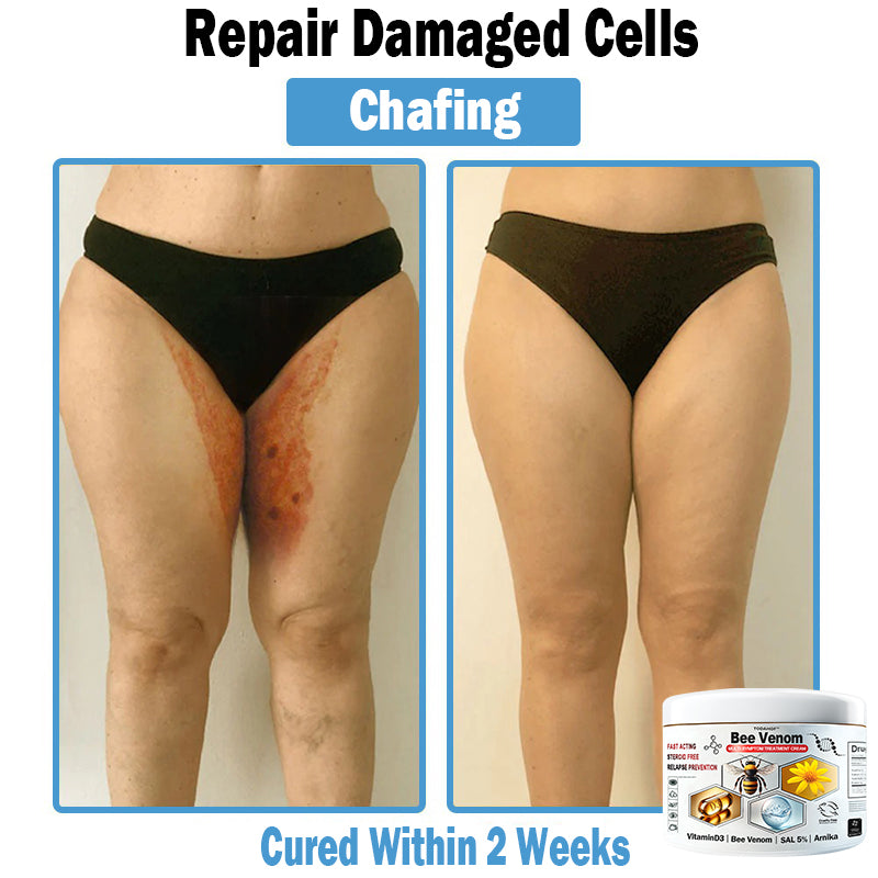 ✅Chafing — Complete Firming Solution
